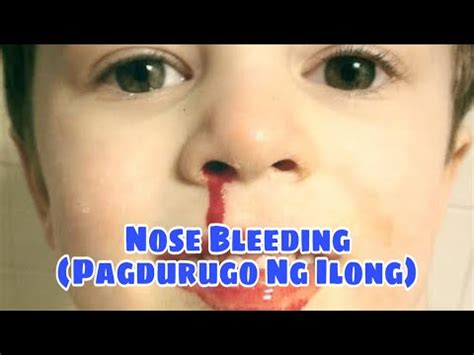 Pagdurugo ng Ilong o Nose Bleeding .